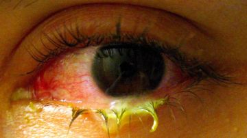 Un ojo dañado por el uso inapropiado de lentes de contacto de colores.