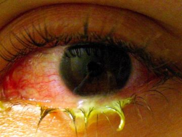 Un ojo dañado por el uso inapropiado de lentes de contacto de colores.