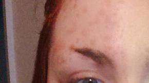 Sophia Ridlington padece soriasis y se maquilla para ocultarlo.