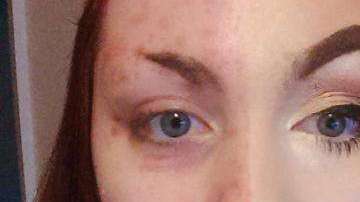 Sophia Ridlington padece soriasis y se maquilla para ocultarlo.