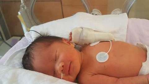 Eiko, que se ve aquí en la UCI neonatal del Hospital Mount Sinai, fue dada por cesárea el 19 de agosto, más de dos meses después de haber sido operada dentro del útero de su madre.