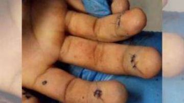 Jesús "El Kalimba" Martín se había operado las yemas de los dedos para borrar sus huellas dactilares, según la fiscalía.