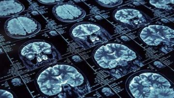 El Alzheimer deteriora el cerebro, especialmente la memoria y el pensamiento.