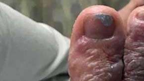 Debido a la infección, Eddie Zytner y Katie Stephens deben andar con muletas.