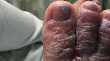 Debido a la infección, Eddie Zytner y Katie Stephens deben andar con muletas.