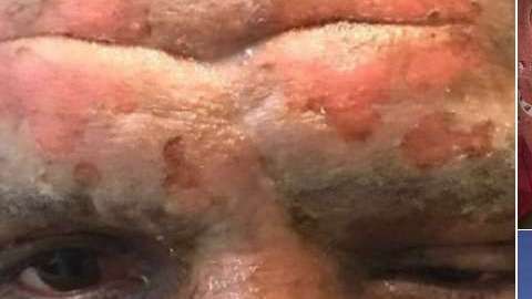 Lucas Viatri, delantero del Peñarol de Uruguay, sufrió quemaduras de tercer grado