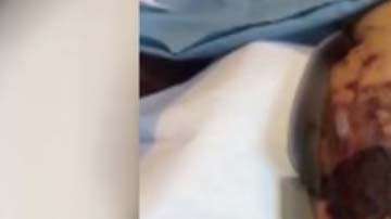 La mayoría de los casos de la infección en Estados Unidos ocurren entre mayo y octubre.