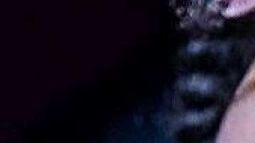 Aria Elisson desarrolló vitíligo tras padecer meningitis.