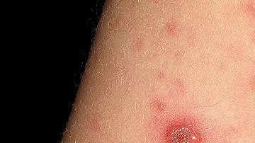 Luego del tercer o cuarto día de la infección, la persona desarrolla una erupción en casi todo el cuerpo.