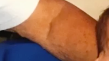 Jaimeson y Anderson tienen una enfermedad que les ha transformado la cara y ambos sufrieron acoso escolar de pequeños.