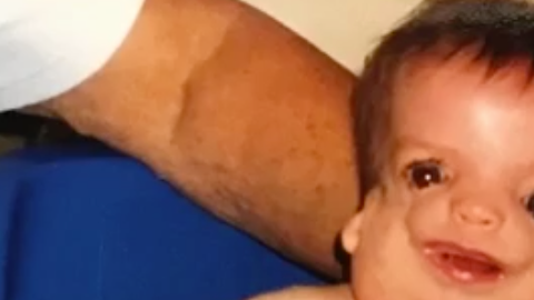 Jaimeson y Anderson tienen una enfermedad que les ha transformado la cara y ambos sufrieron acoso escolar de pequeños.