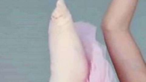 Las numerosas operaciones a las que fue sometida Pollyanna Hope no le impidieron cumplir su sueño de ser bailarina.