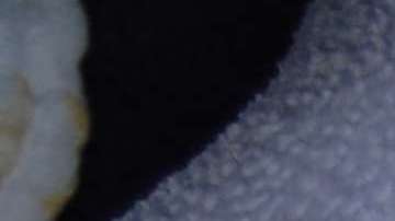 El sarampión es una enfermedad contagiosa.