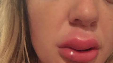 Jessica Bennett  sufrió de inflamación por una semana.