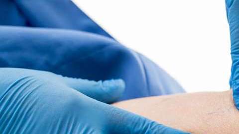 Las várices pueden derivar en algo peligroso.