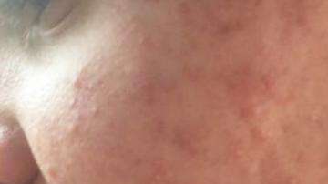 El acné quístico de un adolecente con autismo.