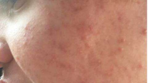 El acné quístico de un adolecente con autismo.