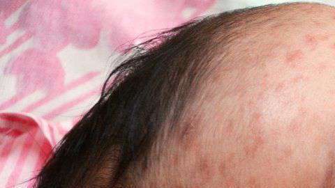 El sarampión se contagia con facilidad entre individuos susceptibles.