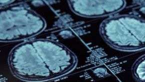El Alzheimer deteriora el cerebro, especialmente la memoria y el pensamiento.