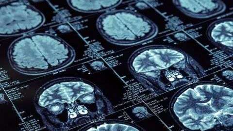 El Alzheimer deteriora el cerebro, especialmente la memoria y el pensamiento.