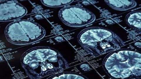 El Alzheimer deteriora el cerebro, especialmente la memoria y el pensamiento.