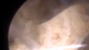 En el video, se ve claramente los vellos y cartílagos.