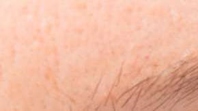 El glaucoma es la primera causa de ceguera en EEUU.