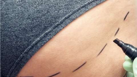 El levantamiento de glúteos es un procedimiento cada vez más popular.