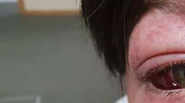 Los médicos compararon las lesiones de Tyler con las sufridas por los pilotos de combate cuando no están usando una máscara de oxígeno.