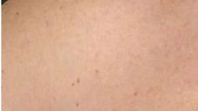 Nadie está exento del cáncer mamario