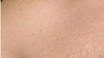 Nadie está exento del cáncer mamario