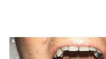 Son varios los factores que pueden ennegrecer la lengua.