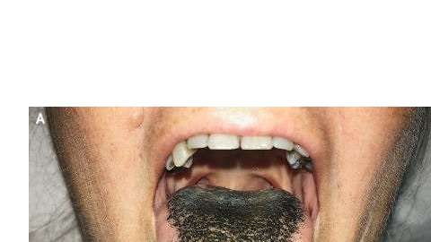 Son varios los factores que pueden ennegrecer la lengua.