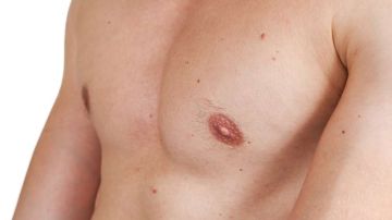 Los hombres tienen muy pocas probabilidades de desarrollar cáncer de mama.