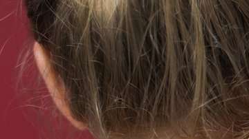 Hay picaduras que apenas notamos. Otras son muy molestas.