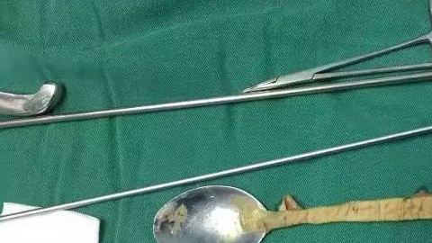 El hospital mostró la cuchara que le extrajeron al paciente.