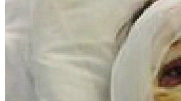 La paciente sufrió quemaduras en el 90 % de su cuerpo.