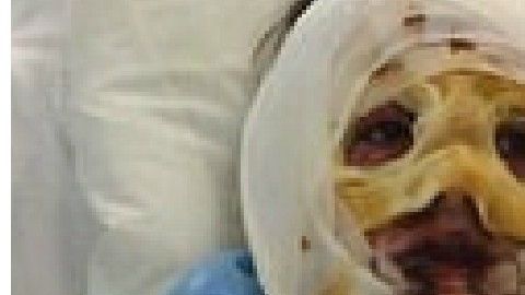 La paciente sufrió quemaduras en el 90 % de su cuerpo.