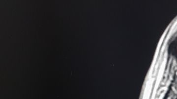 Así se ve un tumor cerebral en una resonancia magnética.