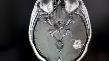 Así se ve un tumor cerebral en una resonancia magnética.