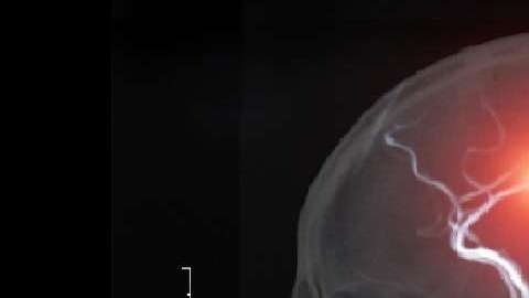 Un derrame cerebral puede tener serias consecuencias.