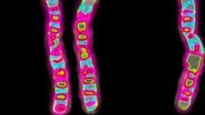 Con la edición genética se inserta un gen para reparar el gen defectuoso.