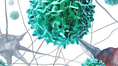 La mielitis flácida aguda surge repentinamente.