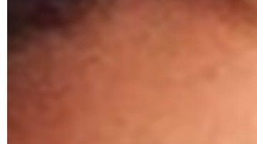 La joven contrajo una infección por querer agrandarse los labios.