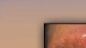 En tres días, sus cejas comenzaron a infectarse.