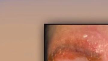 En tres días, sus cejas comenzaron a infectarse.