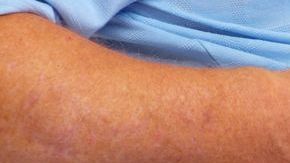 El exceso de ruido puede desencadenar trastornos en el metabolismo.