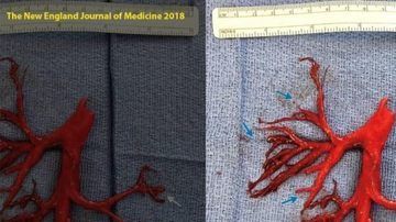 Parte del pulmón del paciente.