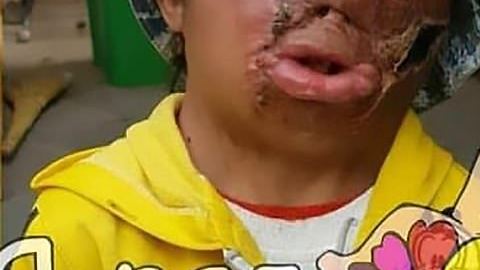 Bakhtiyer Sindrov sufrió quemaduras siendo un bebé.