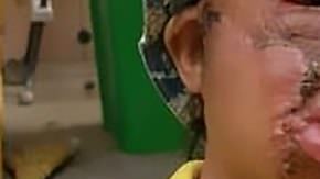 Bakhtiyer Sindrov sufrió quemaduras siendo un bebé.